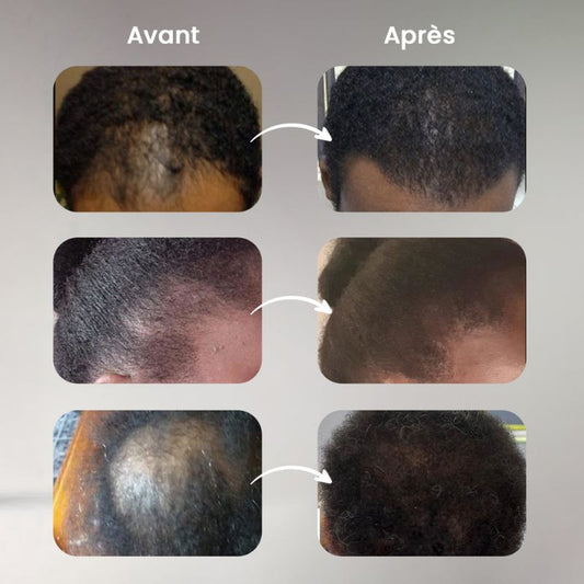 Fibres Capillaires pour la Perte de Cheveux